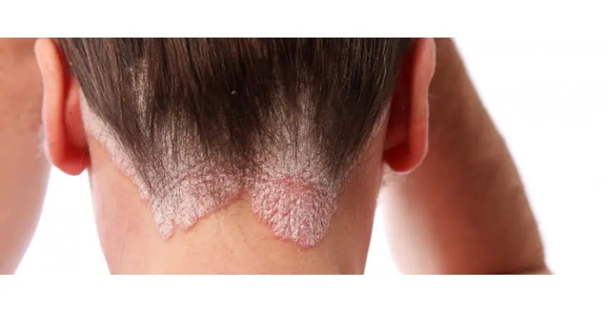 Aloe arborescens, un rimedio per la psoriasi