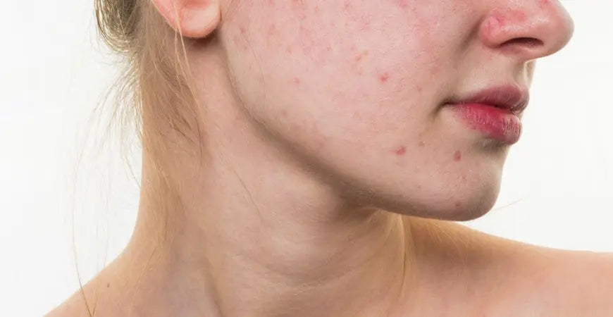 Contro l’acne, la forza dell’aloe arborescens